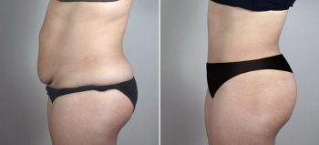 Liposuction Patient 57