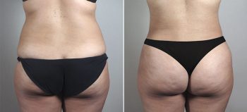 Liposuction Patient 57