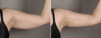 Upper Arm Rejuvenation Patient 13 – Liposuction