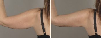 Upper Arm Rejuvenation Patient 13 – Liposuction