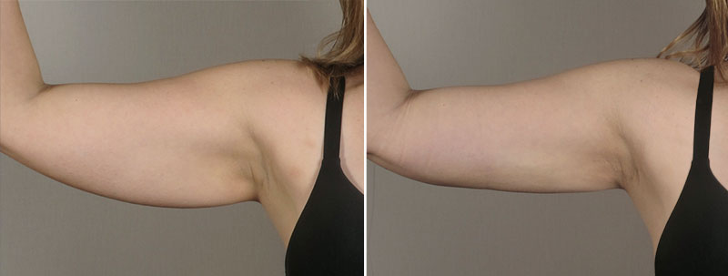 Upper Arm Rejuvenation Patient 13 – Liposuction