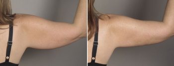 Upper Arm Rejuvenation Patient 13 – Liposuction