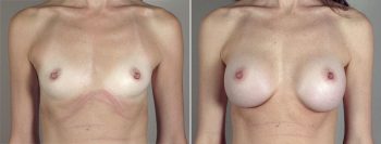 Breast Enlargement (Augmentation) Patient 69