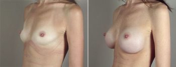 Breast Enlargement (Augmentation) Patient 69