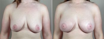 Breast Enlargement (Augmentation) Patient 70
