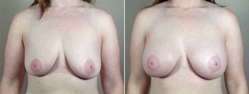 Breast Enlargement (Augmentation) Patient 70