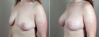 Breast Enlargement (Augmentation) Patient 70