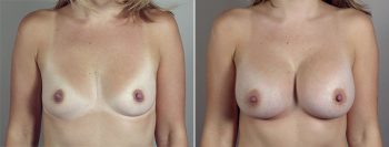 Breast Enlargement (Augmentation) Patient 71