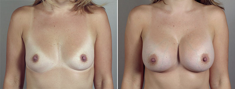 Breast Enlargement (Augmentation) Patient 71