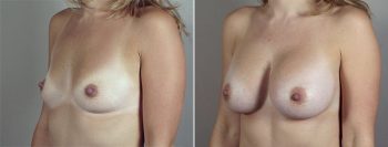 Breast Enlargement (Augmentation) Patient 71