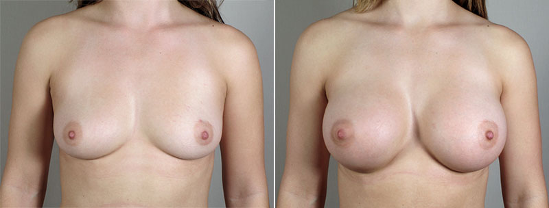 Breast Enlargement (Augmentation) Patient 72