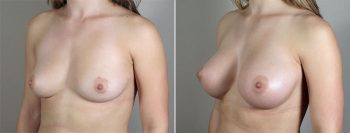 Breast Enlargement (Augmentation) Patient 72