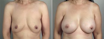 Breast Enlargement (Augmentation) Patient 73