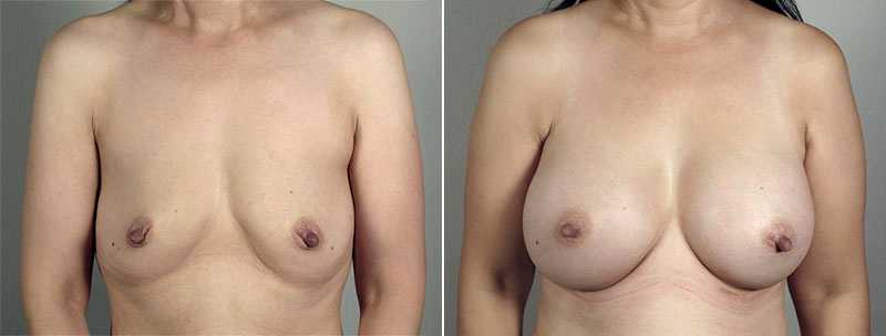 Breast Enlargement (Augmentation) Patient 73