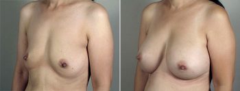 Breast Enlargement (Augmentation) Patient 73