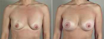 Breast Enlargement (Augmentation) Patient 74