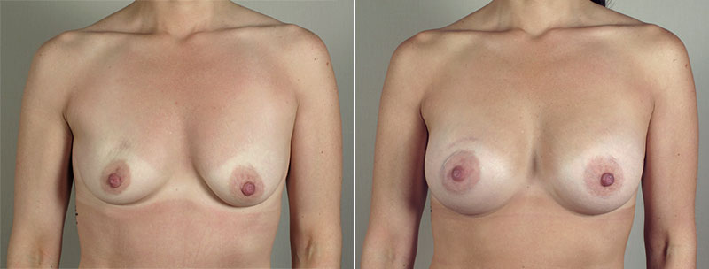 Breast Enlargement (Augmentation) Patient 74