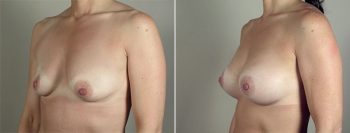 Breast Enlargement (Augmentation) Patient 74