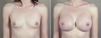 Breast Enlargement (Augmentation) Patient 76