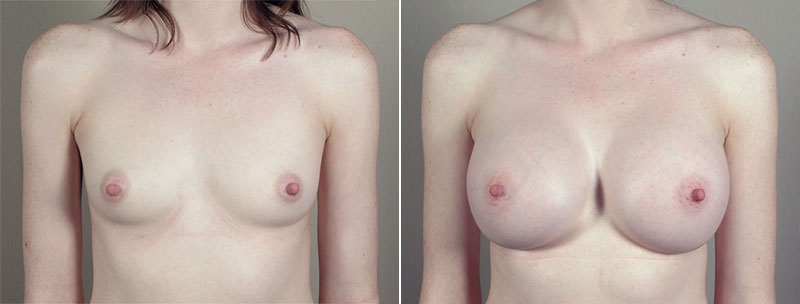 Breast Enlargement (Augmentation) Patient 76