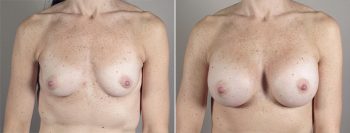 Breast Enlargement (Augmentation) Patient 77