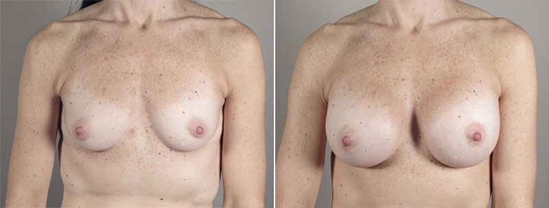 Breast Enlargement (Augmentation) Patient 77