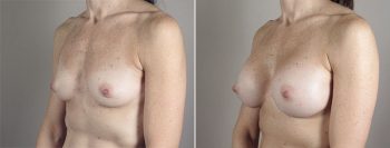 Breast Enlargement (Augmentation) Patient 77