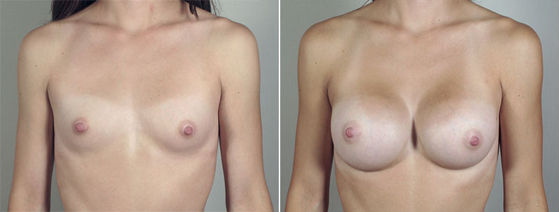 Breast Enlargement (Augmentation) Patient 78