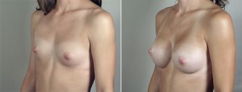 Breast Enlargement (Augmentation) Patient 78