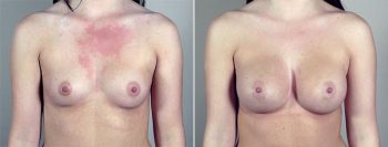 Breast Enlargement (Augmentation) Patient 75