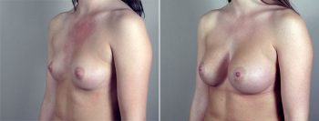 Breast Enlargement (Augmentation) Patient 75