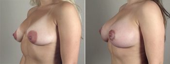 Breast Lift with Implants Patient 32