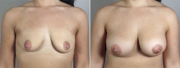 Breast Lift with Implants Patient 33