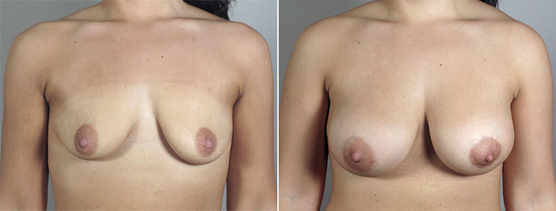 Breast Lift with Implants Patient 33