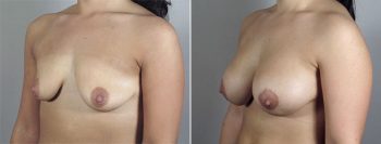 Breast Lift with Implants Patient 33