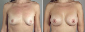 Breast Lift with Implants Patient 34