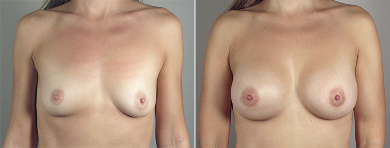 Breast Lift with Implants Patient 34