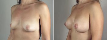 Breast Lift with Implants Patient 34