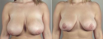 Breast Lift with Auto-Augmentation Patient 5
