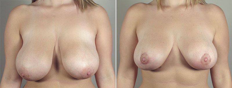 Breast Lift with Auto-Augmentation Patient 5