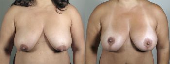 Breast Lift with Implants Patient 35