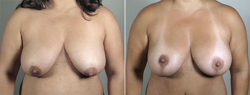 Breast Lift with Implants Patient 35