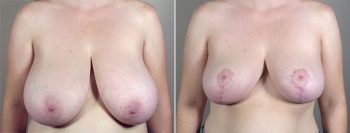 Breast Lift (Vertical Mastopexy) with Reduction Patient 14