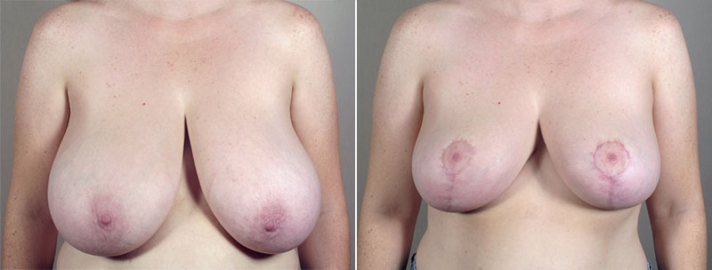 Breast Lift (Vertical Mastopexy) with Reduction Patient 14