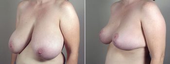 Breast Lift (Vertical Mastopexy) with Reduction Patient 14