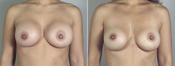 Removal & Replacement of Implants Patient 25