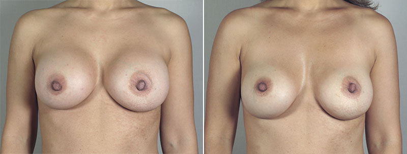 Removal & Replacement of Implants Patient 25