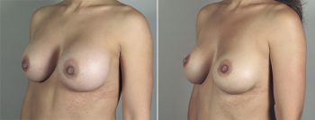 Removal & Replacement of Implants Patient 25