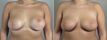 Removal & Replacement of Implants Patient 26