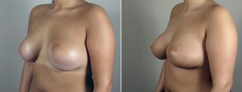 Removal & Replacement of Implants Patient 26